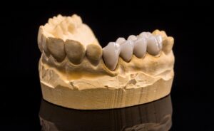 Sztuczne zęby- jakie są ich rodzaje i ile kosztują?